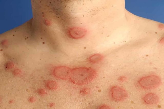 Phát hiện kịp thời trẻ mắc lupus ban đỏ hệ thống